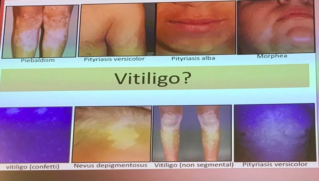Vitiligo session at IMCAS Paris January 2020 - Nanja van Geel -