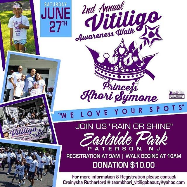 Vitiligo Walk In Nj On June 27 2015