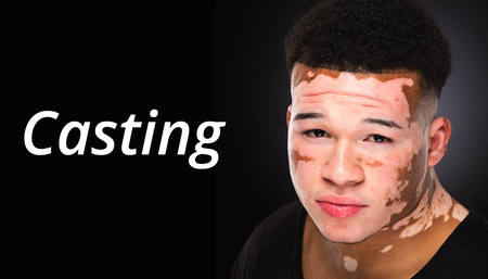 Vitiligo Casting Call