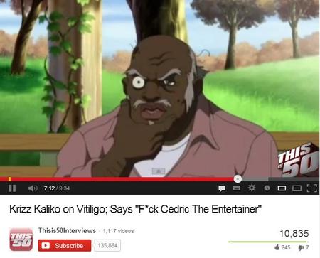 Vitiligo Krizz Kaliko You Tube