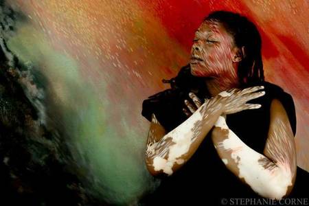 Stephanie Corne Vitiligo Art Project