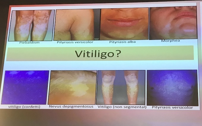 Nanja van Geel - Diagnosis of vitiligo - slide