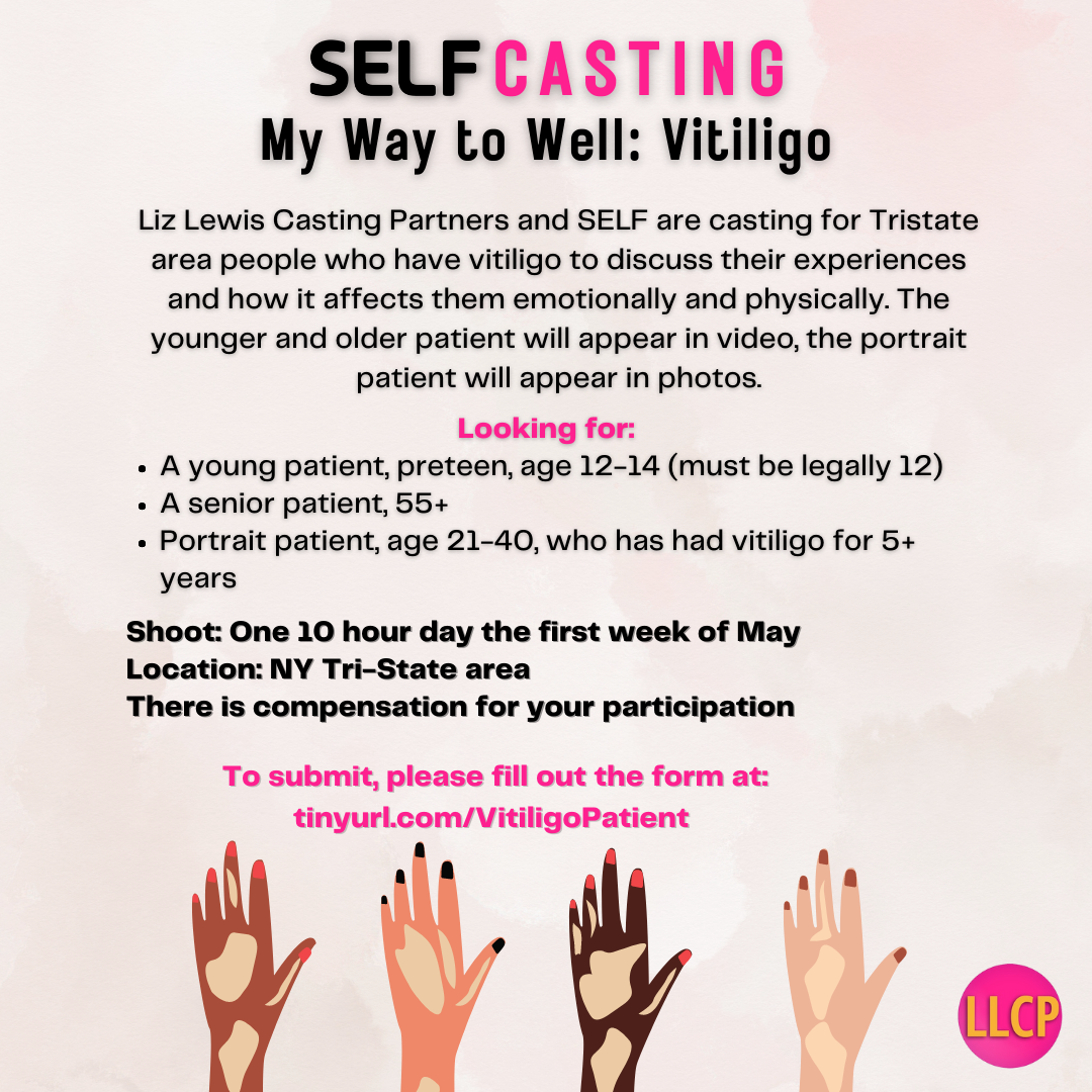Casting call for people with vitiligo in NY Tri-State May 2023
