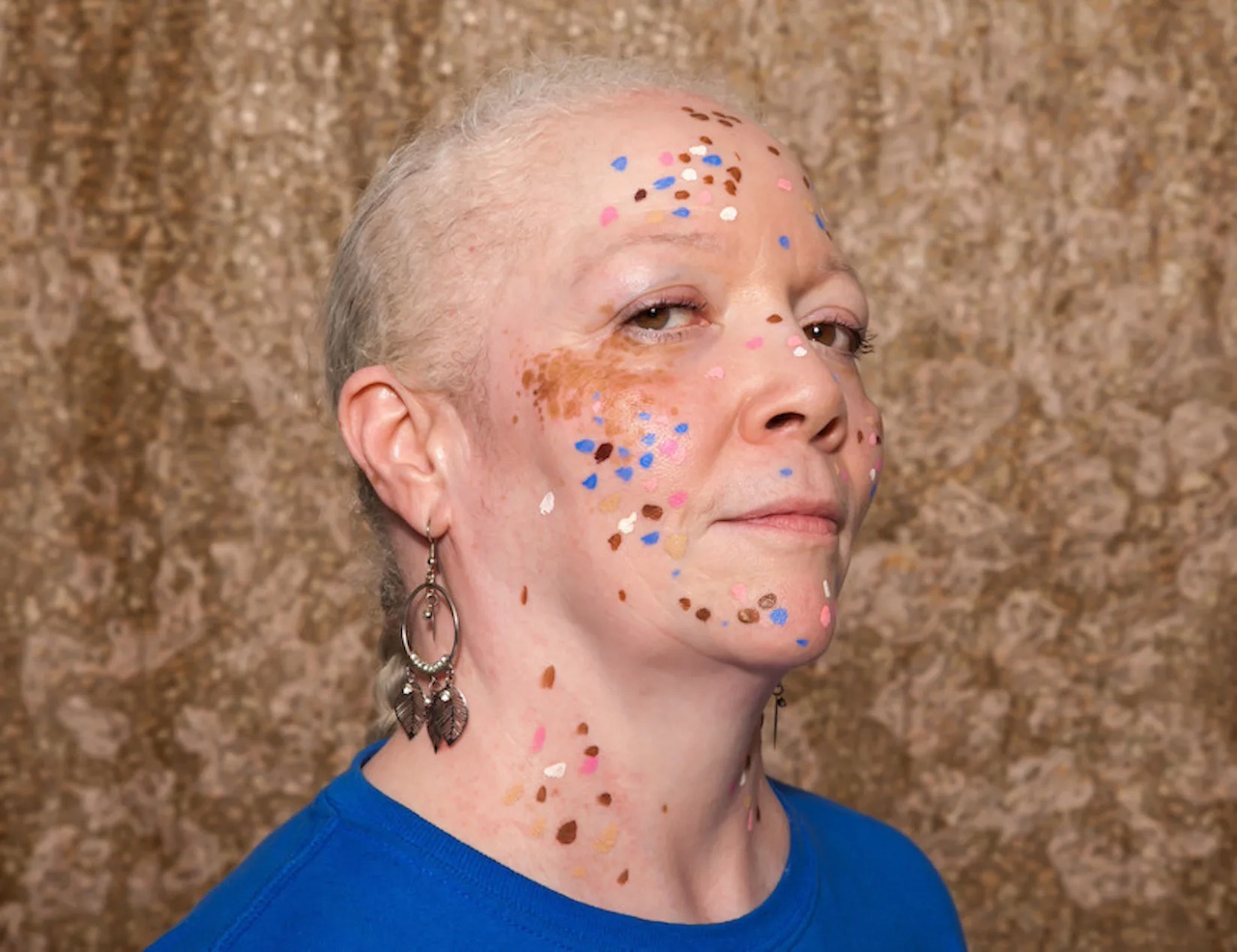World Vitiligo Day 2013 - Stephanie Corne - 1