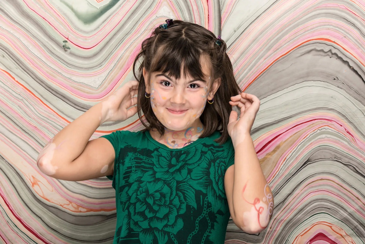 World Vitiligo Day 2013 - Stephanie Corne - 2