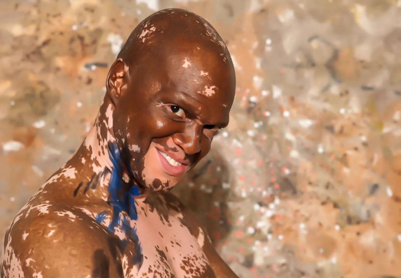 World Vitiligo Day 2013 - Stephanie Corne - Lee Thomas