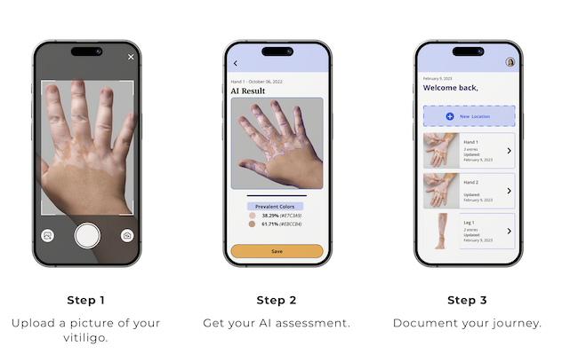 Skinopathy AI for vitiligo