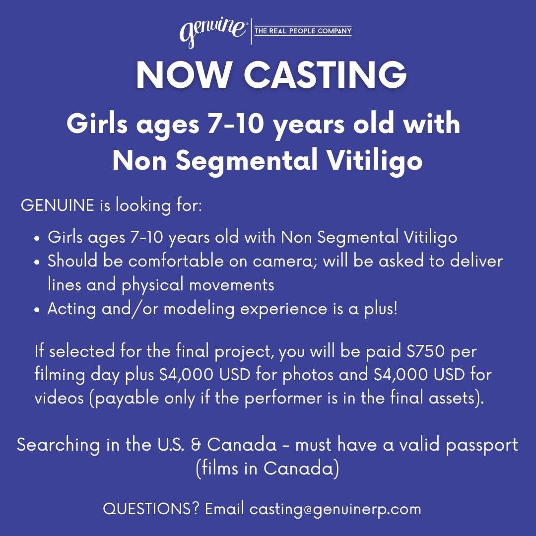 Casting call for vitiligo girls NYC