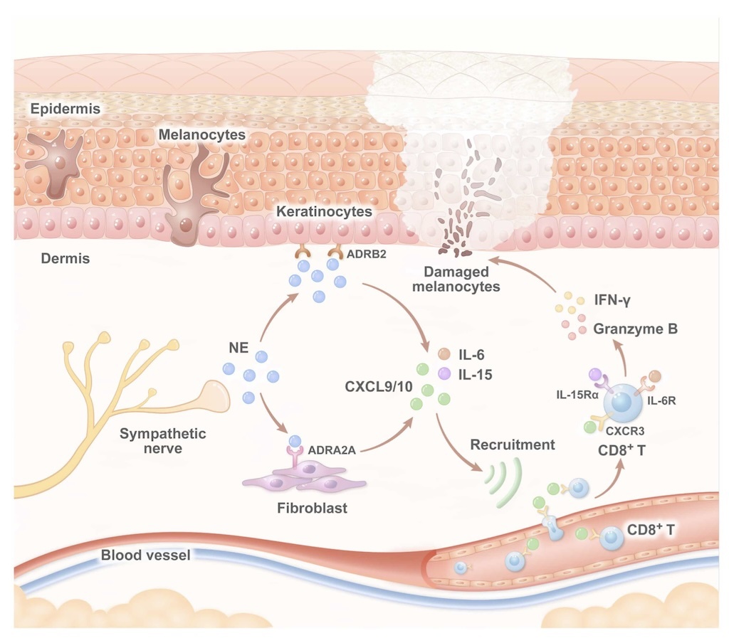 Schematic diagram of sympathetic nerves in vitiligo