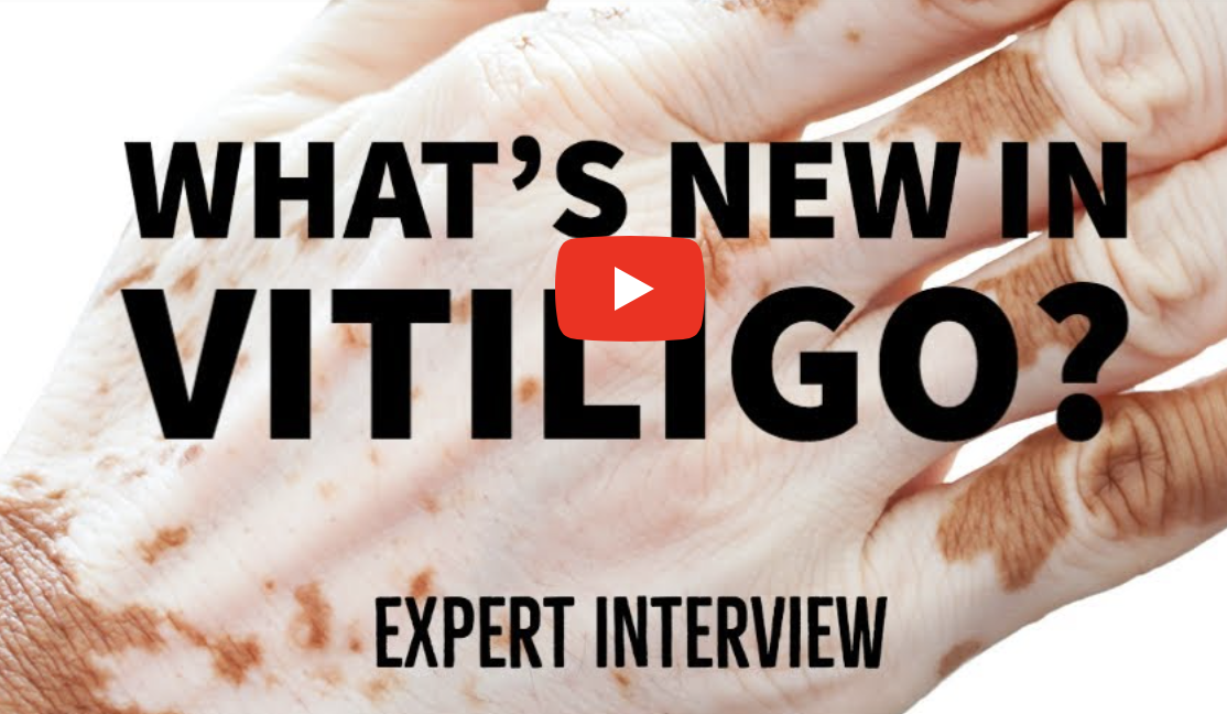 new research vitiligo cure